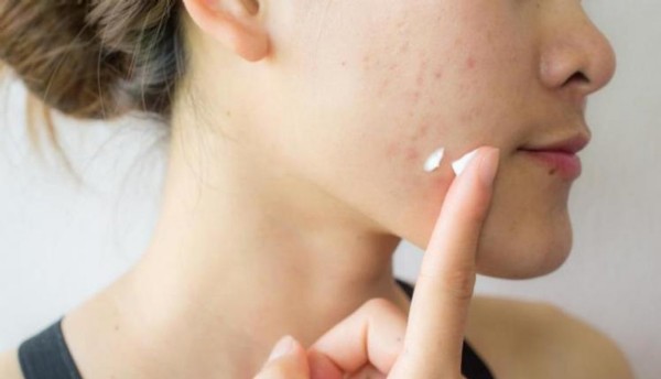 Roaccutane Nedir? Roaccutane Nasıl Kullanılır? Roaccutane Kullananların Yorumları Nelerdir?